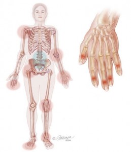 8-inflamacion de articulaciones